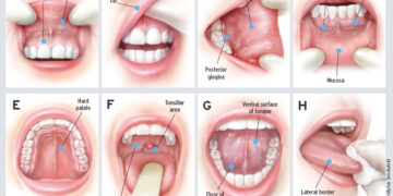 মুখের ক্যান্সার হওয়ার কারণ, লক্ষণ ও এর চিকিৎসা