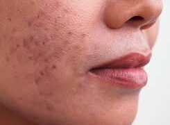 ব্রণ হলে কী করবেন, কী করবেন না