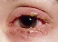 চোখে বিপজ্জনক ইনফেকশনের যত লক্ষণ