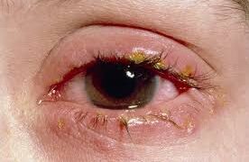 চোখে বিপজ্জনক ইনফেকশনের যত লক্ষণ