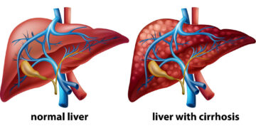 প্রাণঘাতি রোগ লিভার সিরোসিস