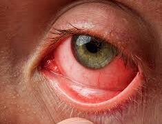 চোখ ওঠা  রোগ