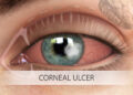 কর্নিয়ায় ঘা চোখের মারাত্মক অসুখ