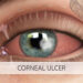 কর্নিয়ায় ঘা চোখের মারাত্মক অসুখ