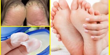 শীতে পা ফাটা