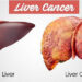 লিভার ক্যান্সার বা হেপাটিক ক্যান্সার
