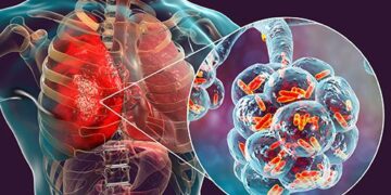 শীতে নিউমোনিয়ার ঝুঁকি