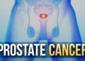 প্রোস্টেট ক্যানসার: যা জানা প্রয়োজন