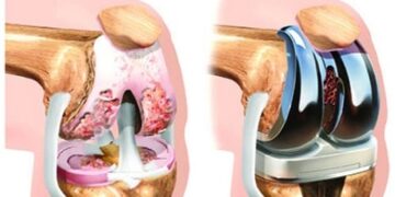 হাঁটু - কোমরের কৃত্রিম প্রতিস্থাপনে সুস্থ জীবন