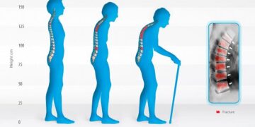 অস্টিওম্যালেসিয়া: হাড় নরম হওয়া রোগ