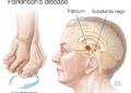 স্নায়ু রোগ পারকিনসন্স