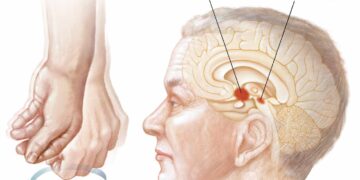 স্নায়ু রোগ পারকিনসন্স