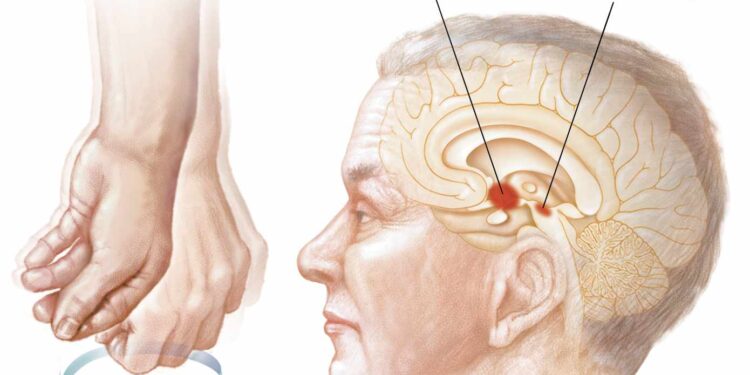 স্নায়ু রোগ পারকিনসন্স