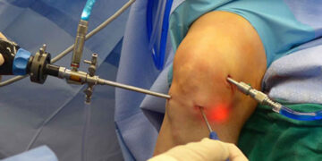 হাঁটুর চিকিৎসায় আর্থ্রাস্কোপি সার্জারি : কখন করবেন