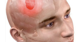 ৮টি লক্ষন বলে দিবে ব্রেইন টিউমার হয়েছে