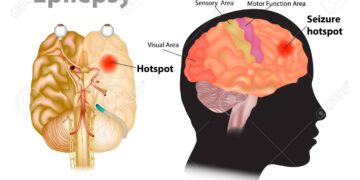 মৃগী রোগের লক্ষণগুলো