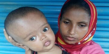 শিশুর মাথা অস্বাভাবিক মোটা?