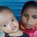 শিশুর মাথা অস্বাভাবিক মোটা?