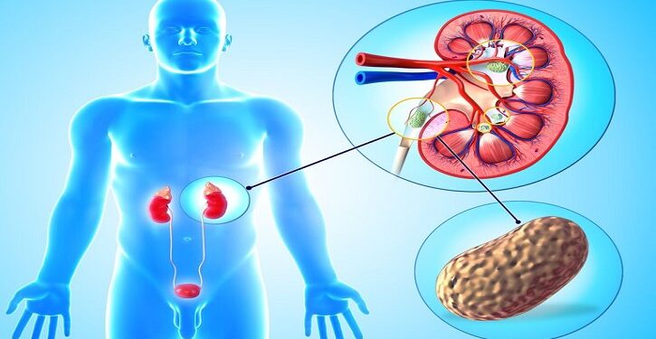 কিডনী রোগের লক্ষণ