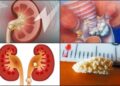 কিডনির পাথর কি ? এর কারন ও প্রকারভেদ