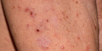 শীতকালে বাড়ে চর্মরোগ