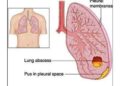 ফুসফুসের ফোঁড়া ও বুকে জমে থাকা পুঁজ
