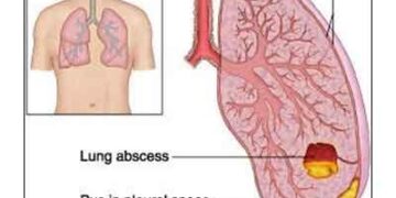 ফুসফুসের ফোঁড়া ও বুকে জমে থাকা পুঁজ