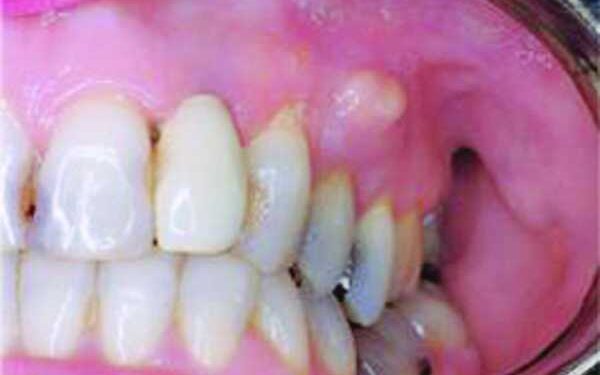 দাঁতের গোড়ায় অ্যাবসেস বা ফোঁড়া