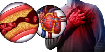 হার্টের ধমনীতে ব্লক ও চিকিৎসা