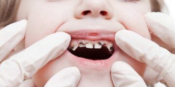 দাঁতের পোকা আসলে কী?