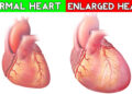 হার্ট বড় হওয়া মোটেই ভালো নয়