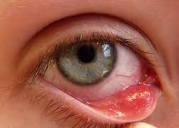 চোখে অঞ্জনি বা স্টাই হলে করণীয়