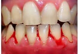 মাড়ি দিয়ে রক্ত পড়ার কারণ ও প্রতিকার