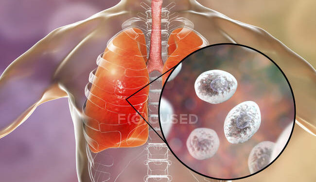 ৬ টি লক্ষণে বোঝা যাবে আপনার ফুসফুসের সমস্যা