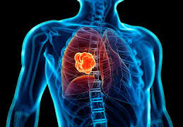 বুকে টিউমার ও প্রতিকার