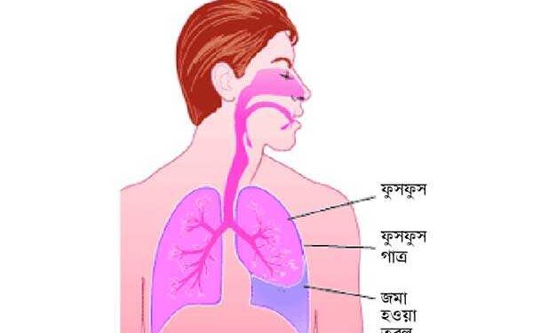 ফুসফুসে পানি জমা রোগের নাম প্লুরাল ইফিউশন