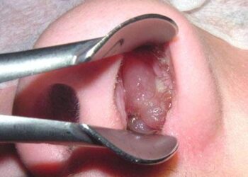 নাকের পলিপ: উপসর্গ, কারণ, চিকিৎসা