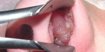 নাকের পলিপ: উপসর্গ, কারণ, চিকিৎসা