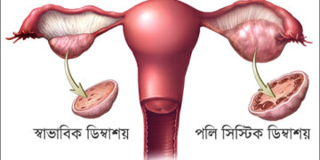 পলি সিস্টিক ওভারি সিনড্রোম কী? জেনে নিন করণীয়