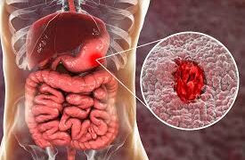 গ্যাস্ট্রিক আলসার রোগের লক্ষণ ও প্রতিকার