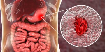 যে ১০ লক্ষণে বুঝবেন আপনার আলসার হয়েছে