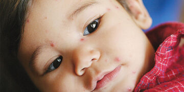 বসন্তে শিশুর জলবসন্ত