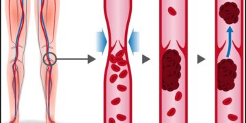 শিরায় রক্ত জমাট বাঁধলে