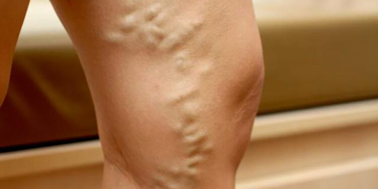 যখন তখন শিরায় টান! হাঁটতে কষ্ট হয়?