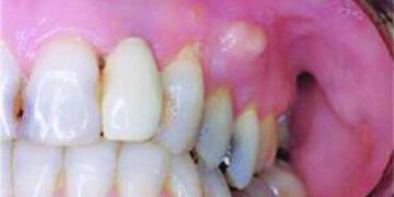 দাঁতের গোড়া ফুলে গেলে