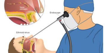 সাইনোসাইটিস চিকিৎসায় এন্ডোস্কোপিক সার্জারি