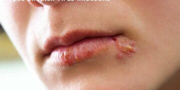 হারপিস সিমপ্লেক্স :এটি একটি ভাইরাস ঘটিত রোগ