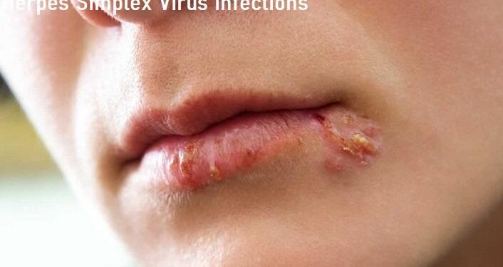 হারপিস সিমপ্লেক্স :এটি একটি ভাইরাস ঘটিত রোগ