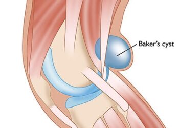 হাঁটুর পিছনে বেকারের সিস্ট ! কারণ ও প্রতিকার