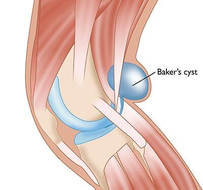 হাঁটুর পিছনে বেকারের সিস্ট ! কারণ ও প্রতিকার